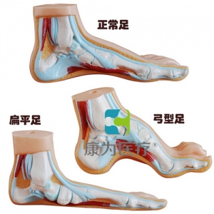 “康為醫(yī)療”正常足、扁平足、弓型足模型