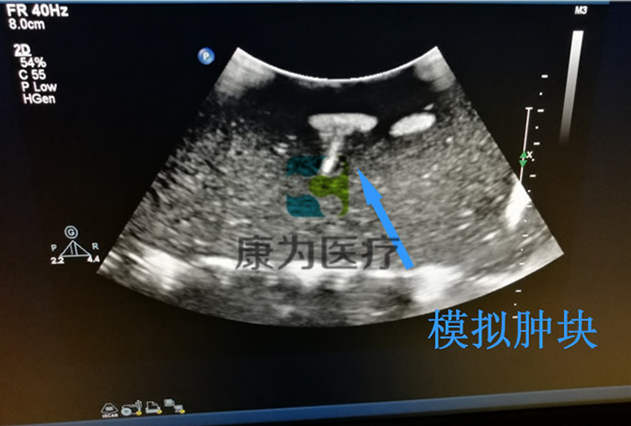 超聲引導下四肢血管活檢模塊